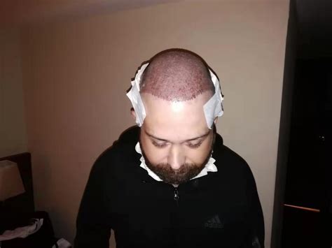 reddit turkey|best hair transplant turkey reddit.